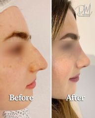 Dott. Matteo D'ambrosio Rinoplastica