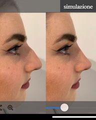 Dott. Matteo D'Ambrosio Rinoplastica Simulazione