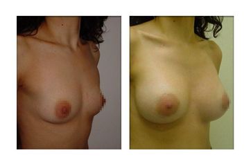 mastoplastica additiva prima dopo