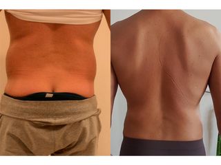 liposuzione prima dopo
