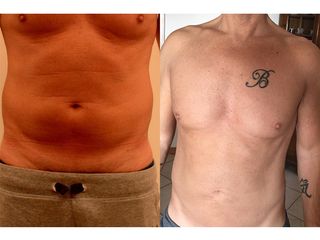 liposuzione prima dopo