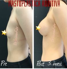 Mastoplastica additiva - Dott.ssa Jasmin Fuhr