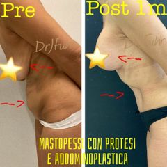 Mastoplastica additiva e Addominoplastica - Dott.ssa Jasmin Fuhr