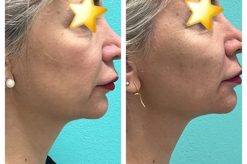 Laserterapia prima e dopo - 862582