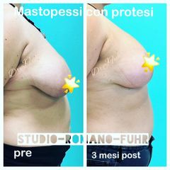 mastopessi con protesi Dott.ssa Jasmin Fuhr