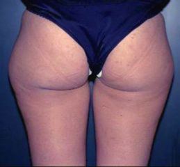 Liposcultura pre