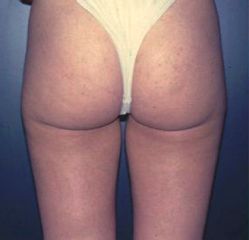 Liposcultura dopo