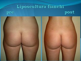 Liposcultura fianchi prima e dopo