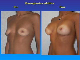 Mastoplastica additiva prima e dopo