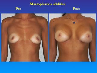 Mastoplastica additiva prima e dopo