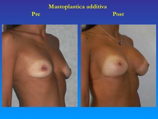 Mastoplastica additiva prima e dopo