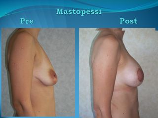 Mastopessi Additiva prima e dopo