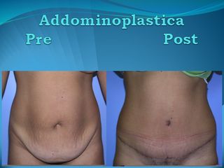 Addominoplastica prima e dopo