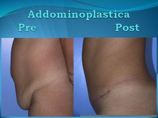 Addominoplastica prima e dopo