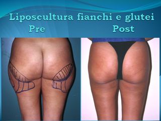 Liposcultura prima e dopo