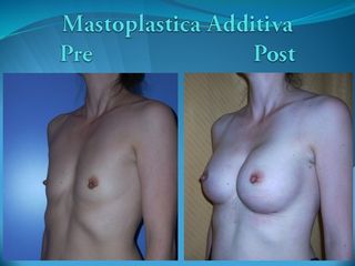 Mastoplastica additiva prima e dopo