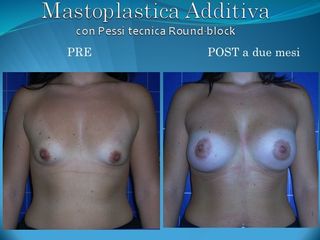 Mastoplastica additiva prima e dopo