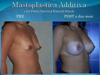 Mastoplastica additiva prima e dopo