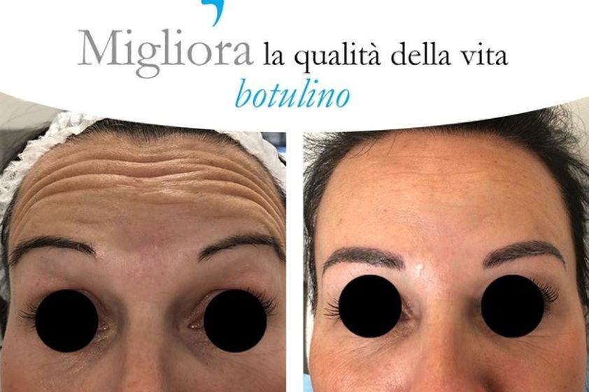 Botulino prima e dopo - 763445