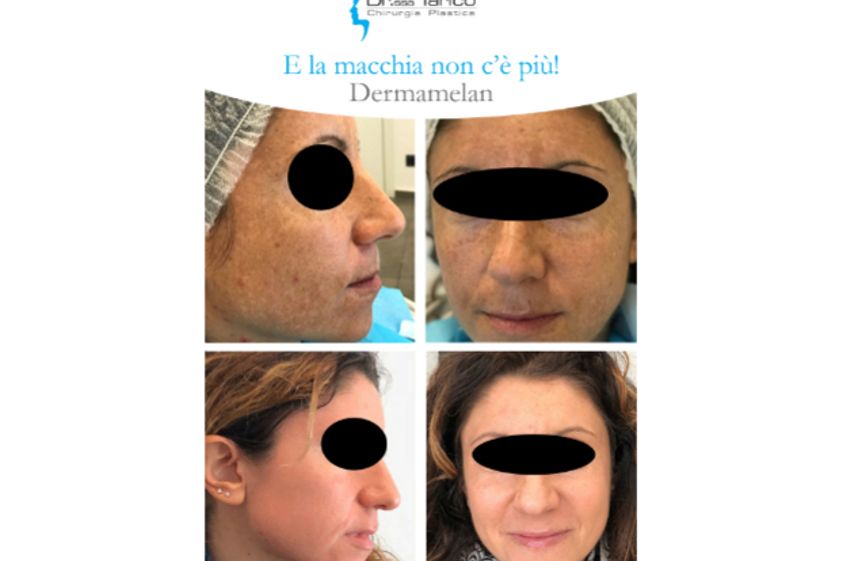 Macchie della pelle prima e dopo - 764464