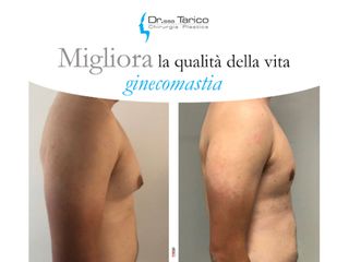 ginecomastia prima dopo