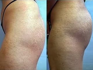 Gluteoplastica prima e dopo