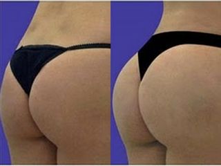 Gluteoplastica prima e dopo