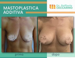 Mastoplastica additiva - Dott. Raffaele Ceccarino