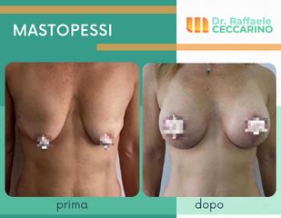 Mastopessi - Dott. Raffaele Ceccarino
