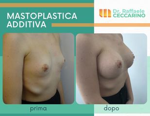 Mastoplastica additiva - Dott. Raffaele Ceccarino