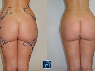 liposcultura prima dopo