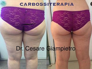 carbossiterapia prima dopo