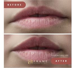 Filler labbra - Frame Beauty Clinic