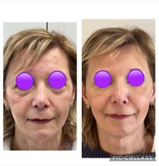 Ringiovanimento viso - Frame Beauty Clinic