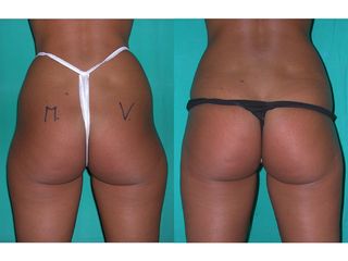 Liposcultura risultati