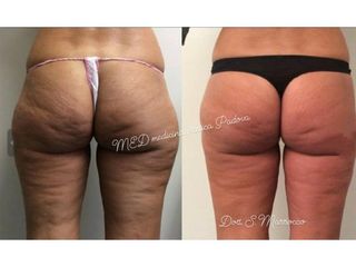 Cellulite - Med Medicina e Chirurgia Estetica