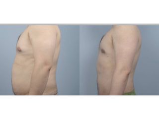 Liposuzione - Chirurgia Estetica Med