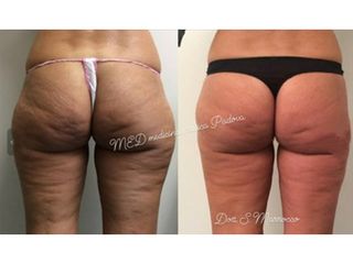 Liposuzione - Chirurgia Estetica Med