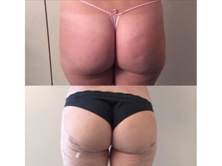 Liposuzione - Chirurgia Estetica Med