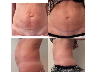 Addominoplastica - Chirurgia Estetica Med
