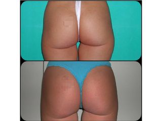 Liposuzione - Chirurgia Estetica Med