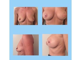 Mastoplastica additiva - Chirurgia Estetica Med