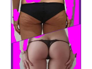 Liposuzione - Chirurgia Estetica Med