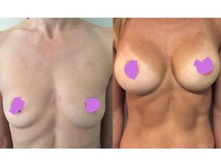 Mastoplastica additiva - Chirurgia Estetica Med