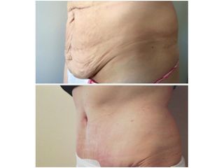Addominoplastica - Chirurgia Estetica Med