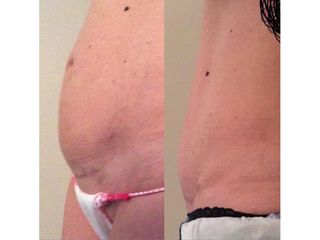 Liposuzione - Chirurgia Estetica Med