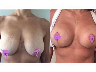Mastoplastica riduttiva - Chirurgia Estetica Med
