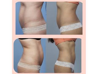 Addominoplastica - Chirurgia Estetica Med