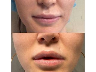 Filler labbra - Med Medicina e Chirurgia Estetica
