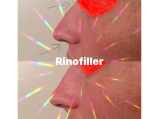 Rinofiller - Med Medicina e Chirurgia Estetica
